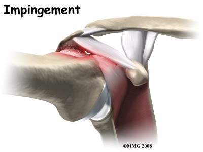 shoulder_impingement.jpg